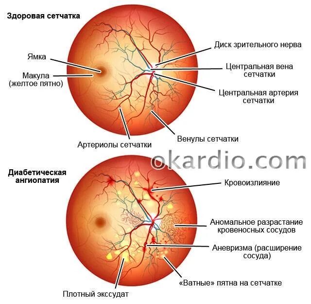 Ангиопатия и ретинопатия сетчатки. Гипертоническая ангиопатия и ретинопатия. Диабетическая офтальмопатия глазное дно. Гипертоническая ангиопатия сетчатки диагноз. Сетчатки по гипертоническому типу