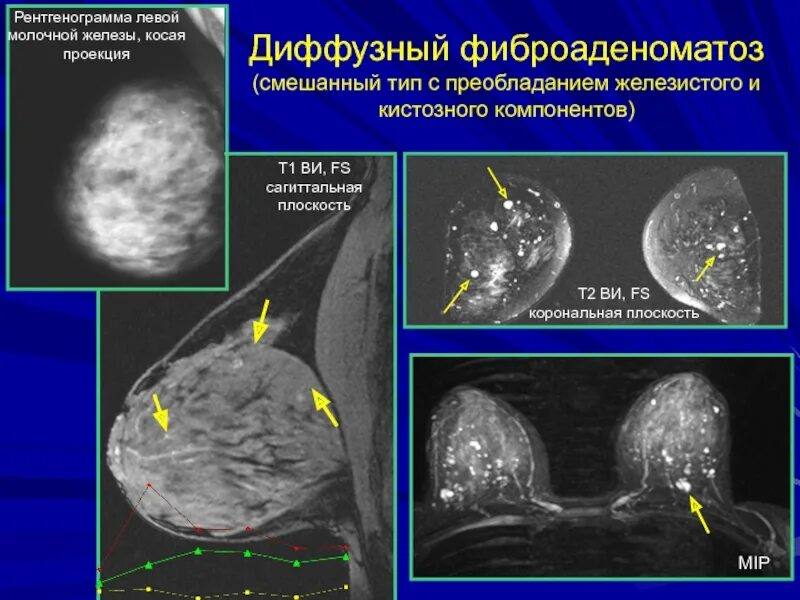 Диффузный фиброаденоматоз молочных желез что это такое