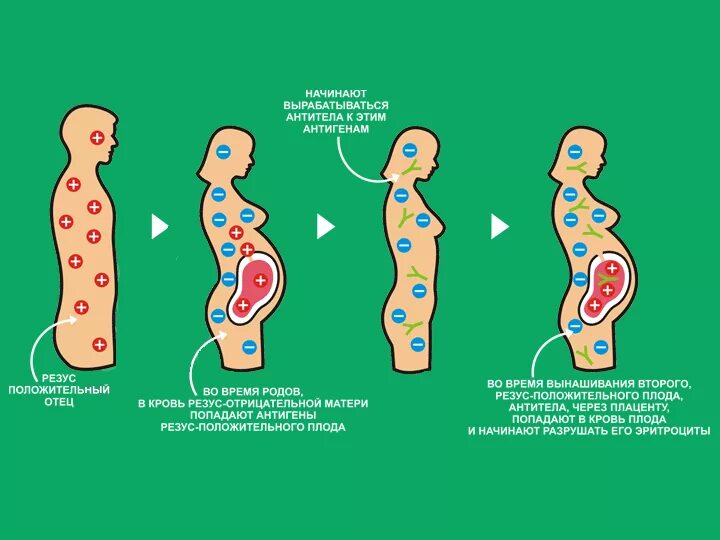 Несовместимость крови матери и плода. Последовательность стадий развития резус- конфликта. Конфликт резус факторов при беременности последствия. Механизм возникновения резус конфликта матери и плода. Механизм развития резус конфликта.