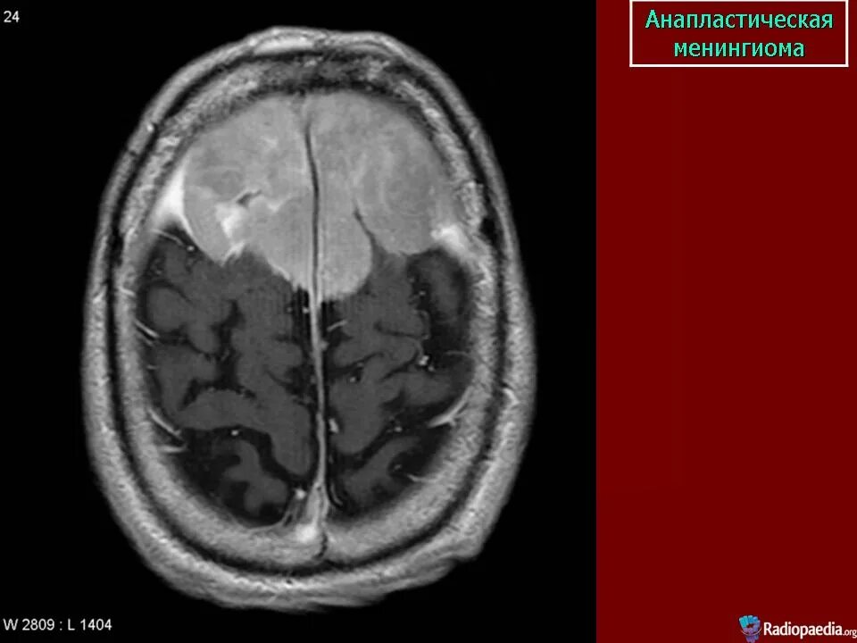 Анапластическая менингиома g3. Менингиома лобной доли кт. Менингиома серпа мозга. Мультифокальная менингиома. После операции менингиомы головного мозга