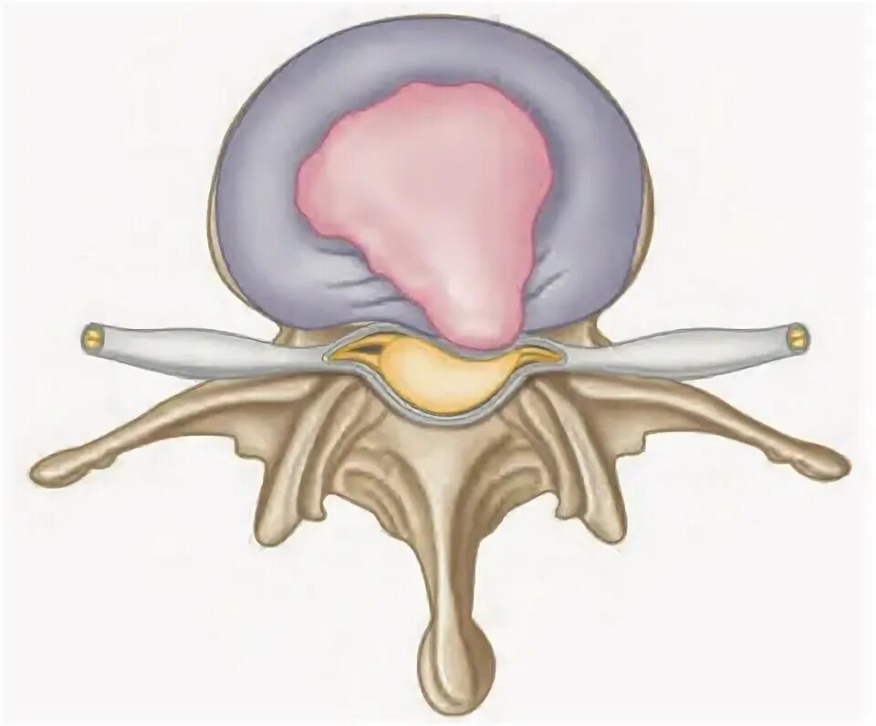 Медианно-парамедианная протрузия диска. Дорзальная срединная грыжа межпозвонкового диска. Дорзальная медианная грыжа. Дорзальные протрузии дисков. Диффузная протрузия межпозвонковых