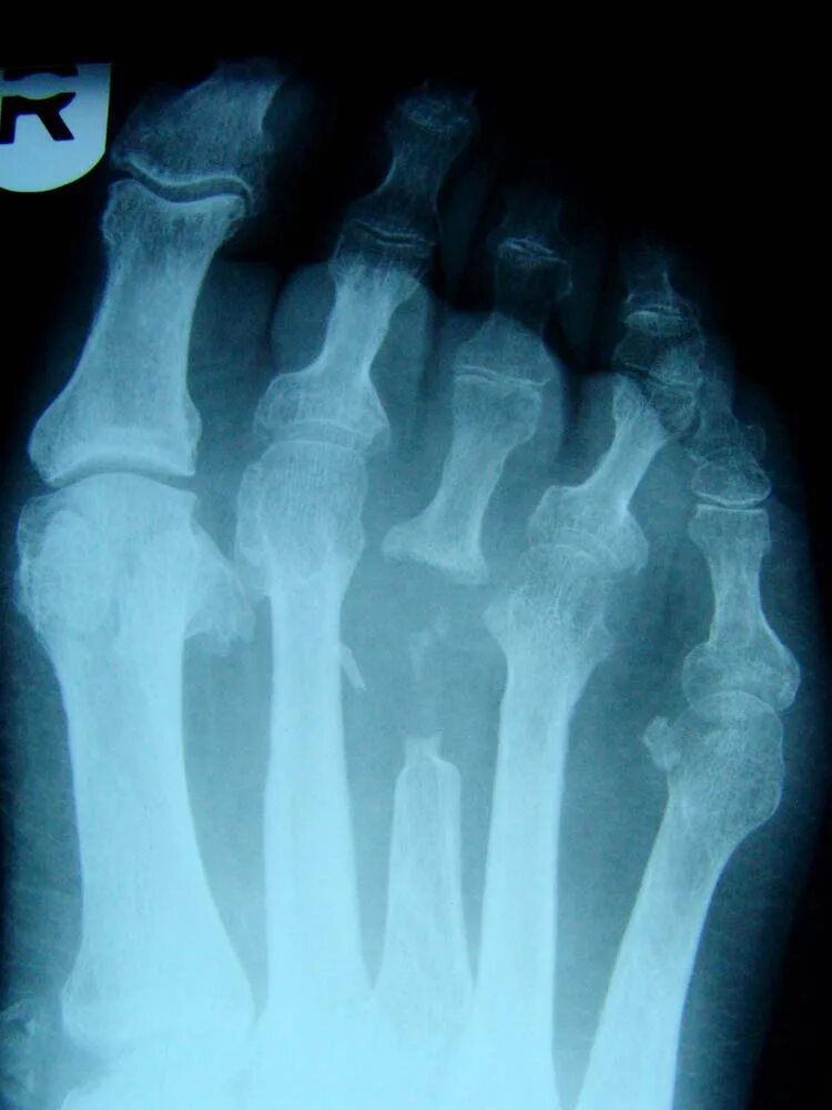 остеомиелит олье рентген. периостит большеберцовой кости на рентгене. хронический остеомиелит голени. хронический остеомиелит голени рентген. нагноение кости.