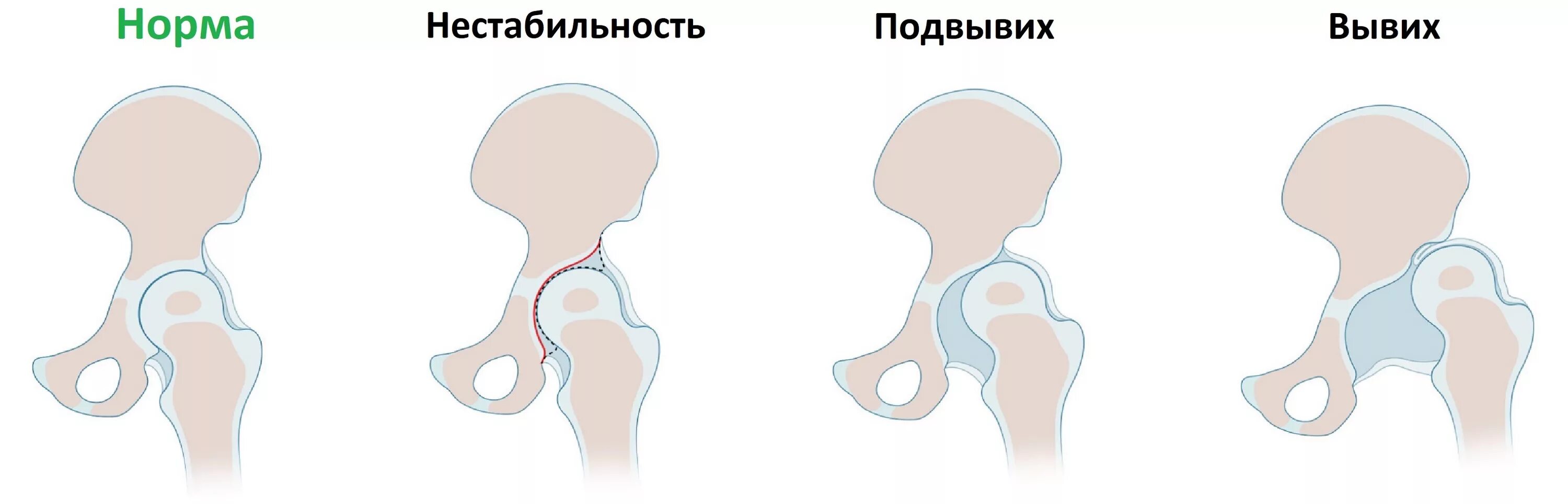 Дисплазия сустава у новорожденного лечение. Врожденный вывих бедра классификация. Степени дисплазии тазобедренных суставов у детей. Врождённая дисплазия ТБС. Дисплазия ТБС классификация.