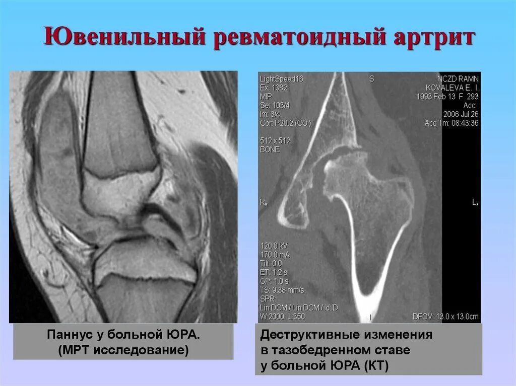 Артрит кт. Рентген суставов при ревматоидном артрите. Ювенильный артрит коленного сустава рентген. Ревматоидный артрит колена кт. Системный ювенильный ревматоидный артрит.