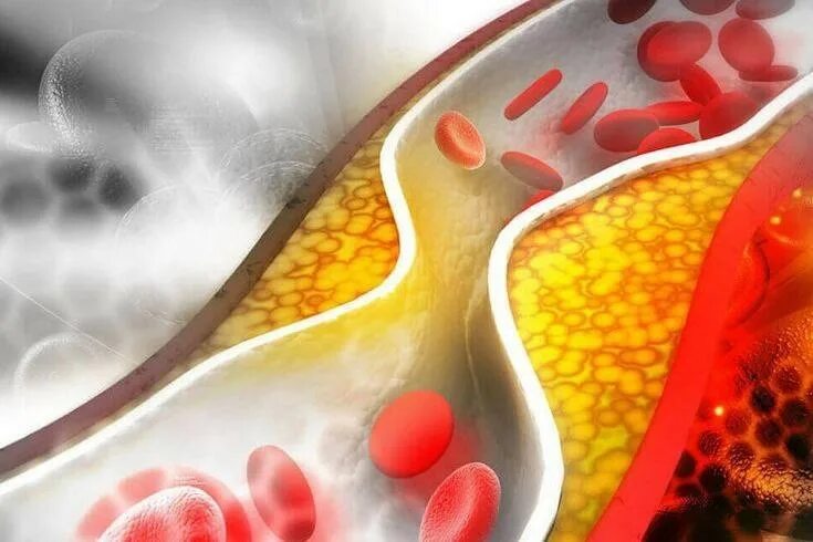 Влияние холестерина в крови. Холестерин в крови. Здоровые сосуды. Повышенный уровень холестерина.