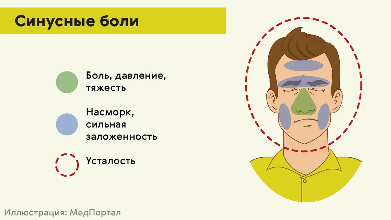 Сильно давит голову что делать. Типы головной боли. Синусная боль головы. Боль в затылке. Синусинаы головная боль.