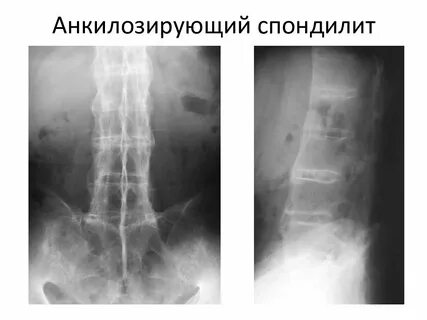 Анкилозирующий спондилит код