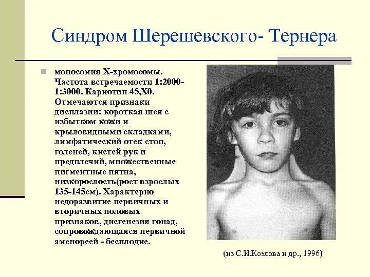 Тип мутации шерешевского тернера. Синдром шерешевского тернера тип мутации. синдром шерешевского частота встречаемости. трисомия шерешевского тернера.