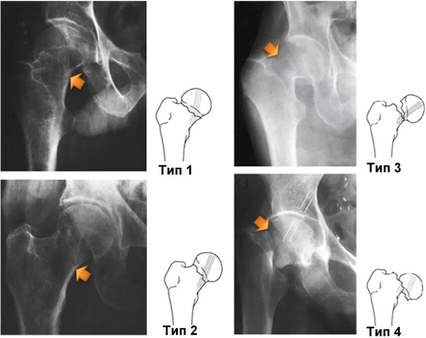 Оскольчатый перелом шейки бедра. Вколоченный перелом шейки бедра классификация. Переломы шейки бедра классификация рентген. Рентгенологическая классификация перелома шейки бедра. Перелом шейки бедра тазобедренного сустава