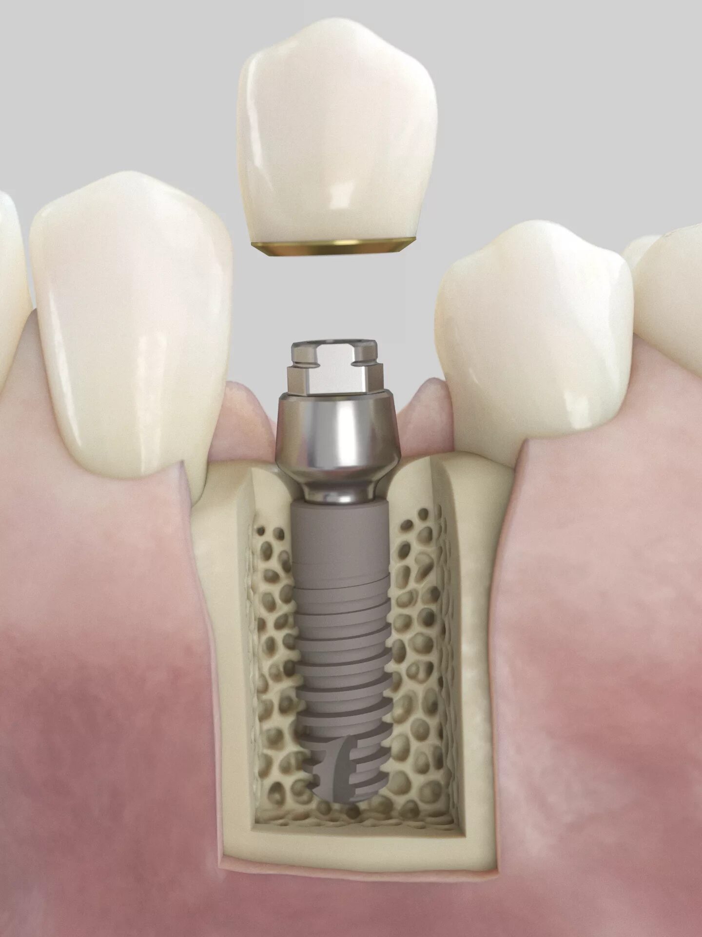 Имплантаты Dentsply. Dentsply Sirona Implants. Имплант Lenmiriot. Astra Tech 3.6.