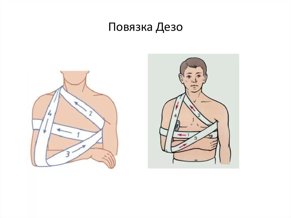 Наложение повязки Дезо. Схема наложения повязки Дезо. Технику наложения повязки Дезо.. Десмургия Дезо.