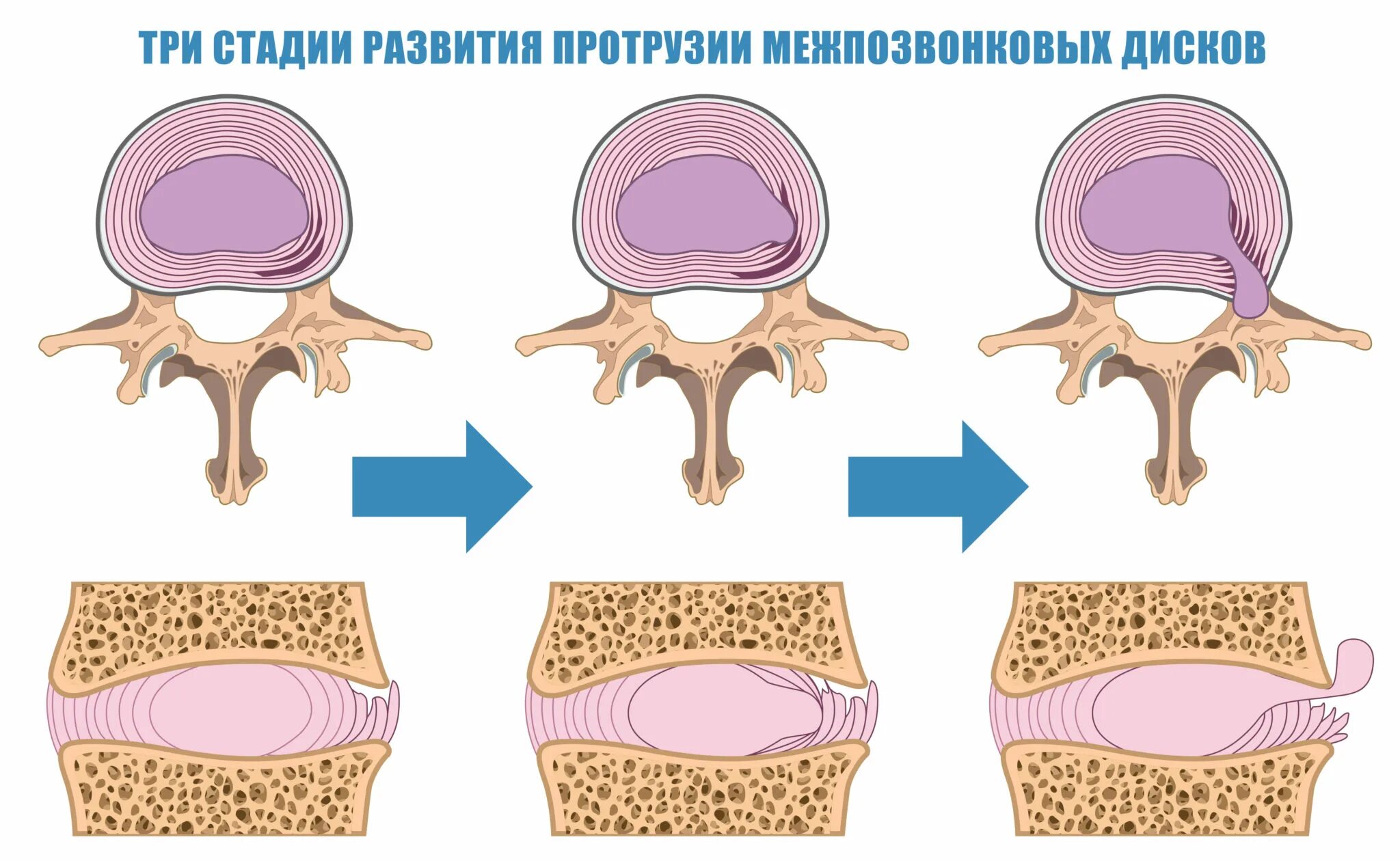 Протрузии межпозвоночного диска. Межпозвонковая грыжа и протрузия. Протрузий межпозвонковых дисков что это такое. Фораминальная протрузия межпозвонкового диска.