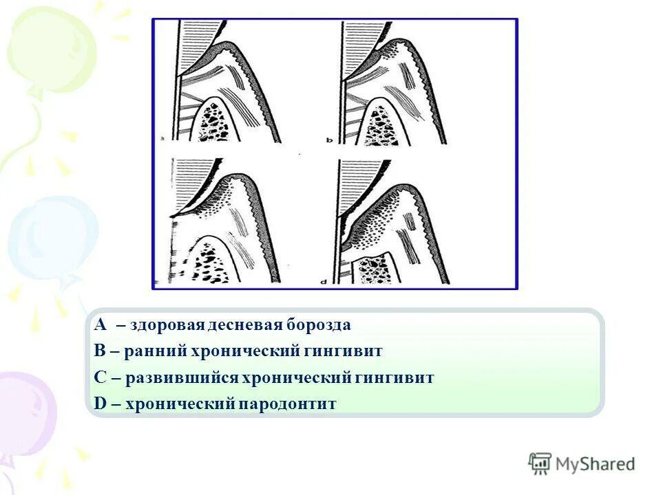 десневой желобок