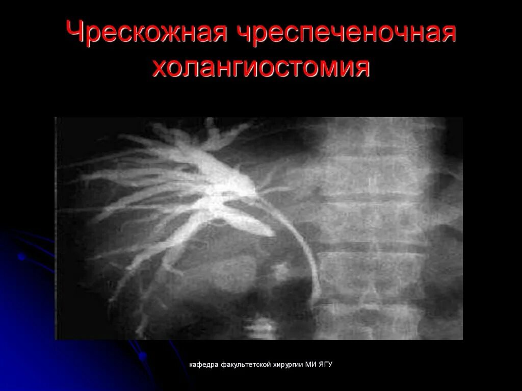 Чрескожная через печеночная холангиография. Чрескожная чреспеченочная дренирование желчных протоков. Чрескожная чреспеченочная холангиостомия дренажи. Чрескожная чреспеченочная холангиография (ччхг). Методика чрескожной чреспеченочной холангиостомии.