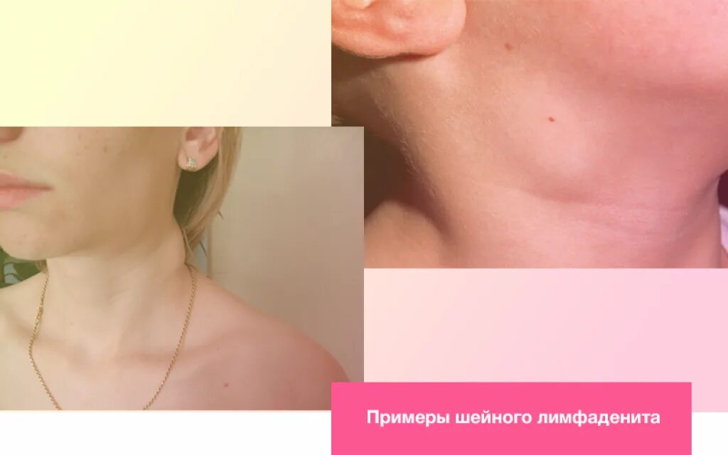 Лимфоузлы у ребенка прощупывается. Трункулярный лимфаденит. лимфаденит лимфатических узлов. лимфоузлы подчелюстные лимфаденит.