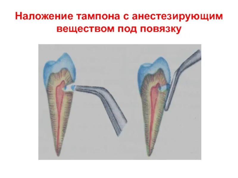 Витальная ампутация пульпы. Витальная экстирпация пульпы. Девитальная экстирпация. Девитальная экстирпация пульпы. Витальная экстирпация презентация.