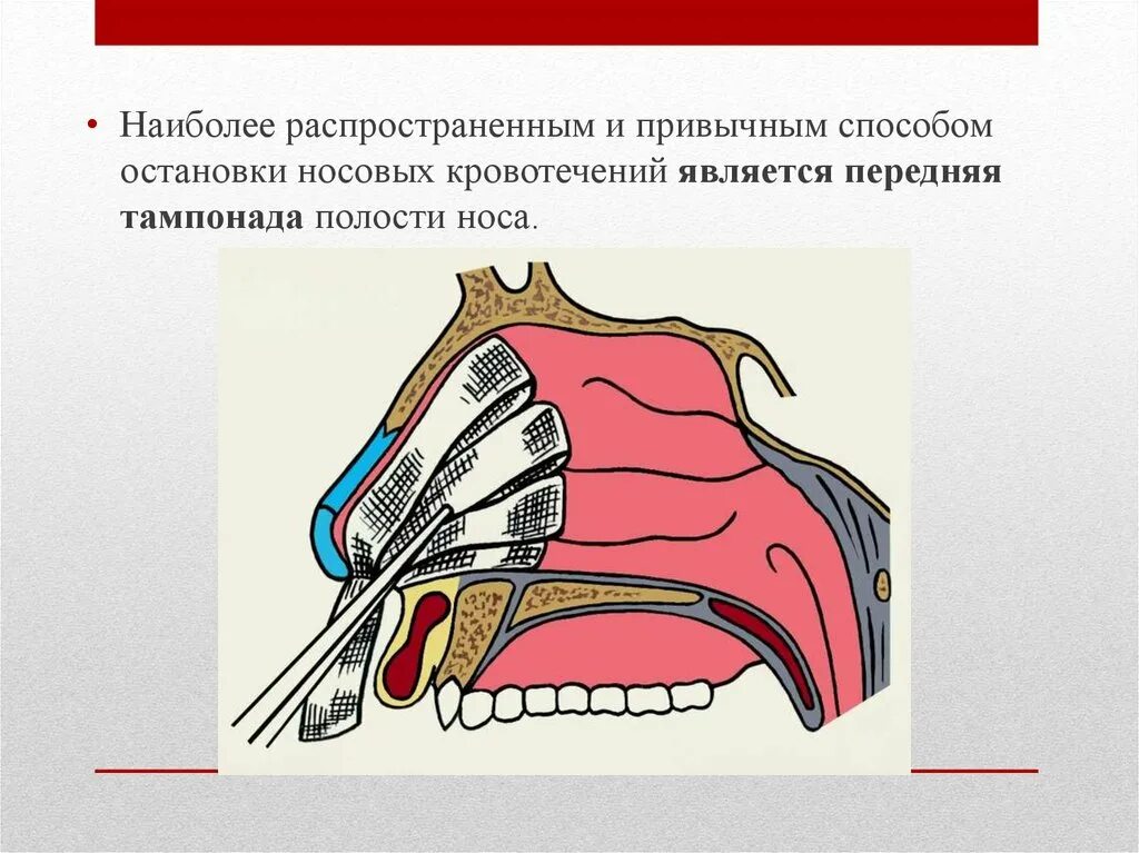 Передняя томпонация полости носа. Остановка носового кровотечения передняя тампонада.