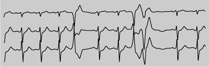 Политопная желудочковая экстрасистолия на ЭКГ. Политопные желудочковые экстрасистолы на ЭКГ. Политопная полиморфная желудочковая экстрасистолия. Мономорфная желудочковая экстрасистолия. Политопные экстрасистолы