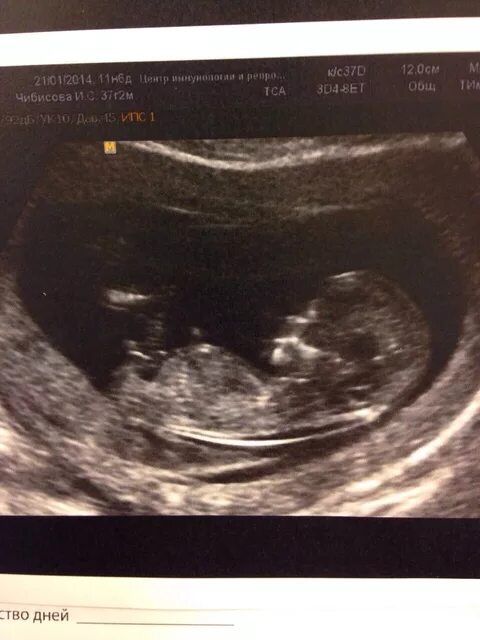 Пол плода на узи в 12 недель беременности. По узи мальчик родила девочку. Мальчик и девочка на узи в 12 недель беременности. Узи девочки и мальчика в 20 недель беременности. Говорили девочка а родился мальчик.