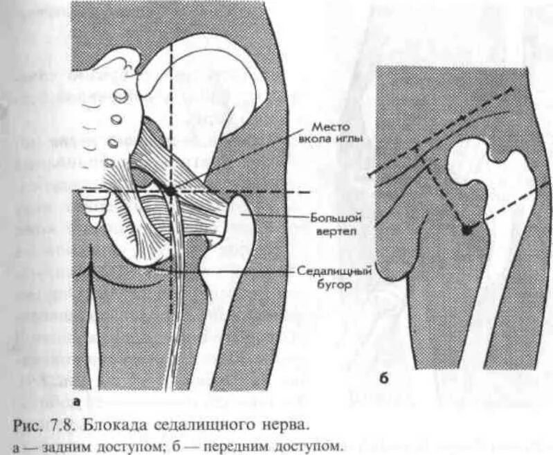 Блокада при защемлении седалищного. Техника блокады седалищного нерва по Войно-Ясенецкому. Блокады седалищного нерва в области верхней трети бедра. Блокада седалищного нерва по Войно-Ясенецкому. Схема блокады седалищного нерва.