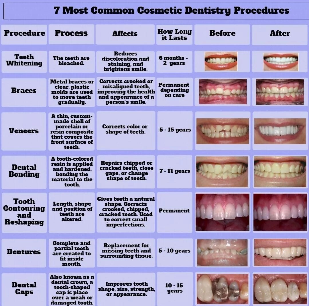 Common process. Cosmetic Dentistry procedure.