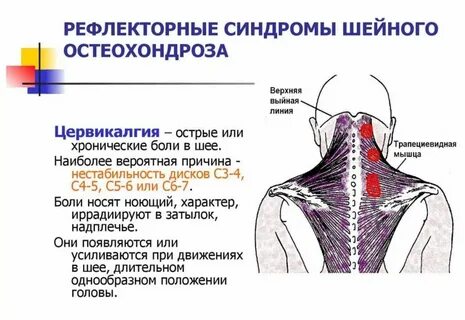 Шейная невралгия симптомы и лечение