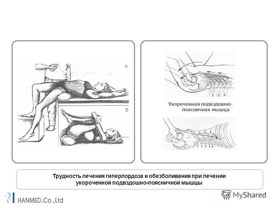 Растяжка квадратной мышцы поясницы упражнения. Растяжка подвздошно поясничной мышцы упражнения. Квадратная мышца поясницы. Подвздошно-поясничная мышца упражнения на расслабление. Мышечное тестирование пояснично подвздошной мышцы.