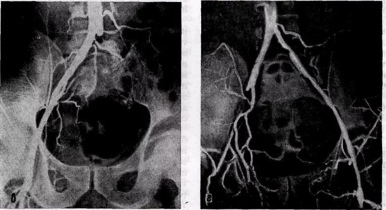 Брюшная ишемия. Варикозное расширение вен малого таза кт. Тромбоз подвздошной артерии кт. Синдром Лериша ангиография.