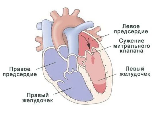 Недостаточность предсердия. Сужение левого предсердно-желудочкового отверстия. Стеноз левого предсердно-желудочкового отверстия. Стеноз правого предсердно-желудочкового отверстия. Стеноз митрального клапана сердца.