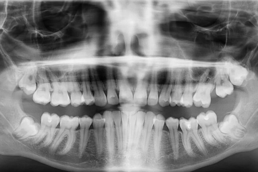 Снимок зубов видное. Кт 3д зубочелюстной системы. Кт верхней и нижней челюсти.