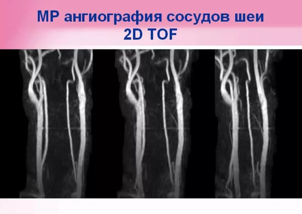 позвоночная артерия мрт. стеноз сосудов шеи мрт. магнитно-резонансная ангиография артерий шеи. ангиография шейного отдела. ангиография шейного отдела.