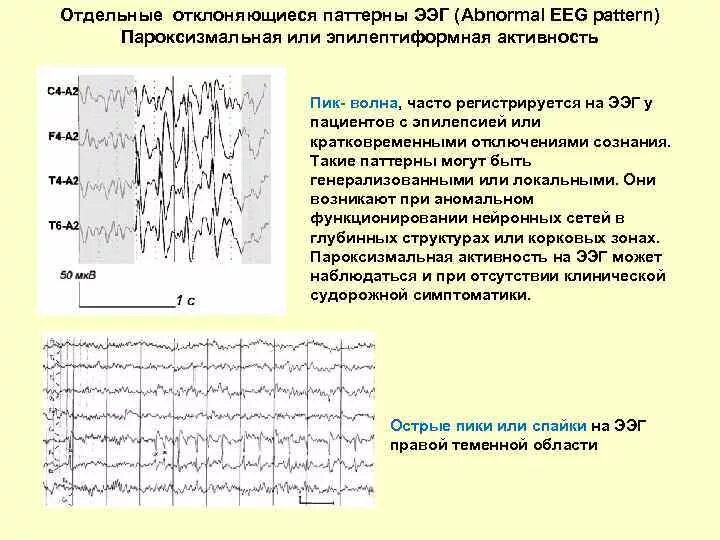 Изменения биоэлектрической активности мозга. Эпилептиформные паттерны на ЭЭГ. ЭЭГ пароксизмальная активность пик волна. Эпилептиформные феномены на ЭЭГ. Пароксизмальная активность на ЭЭГ У ребенка.