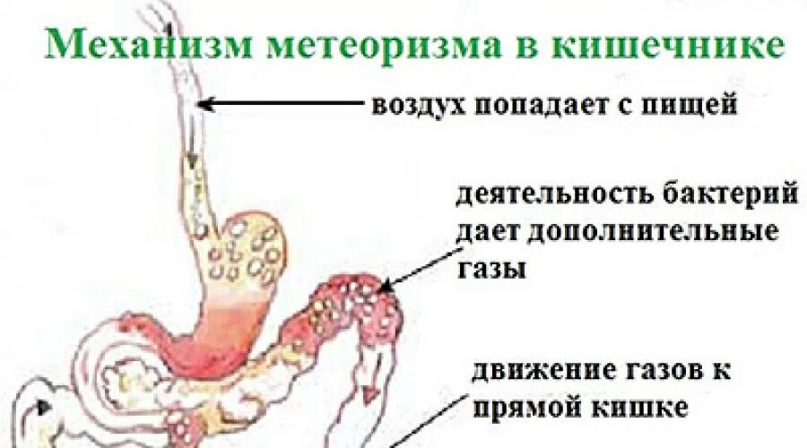 Почему пучит живот и часто отходят газы