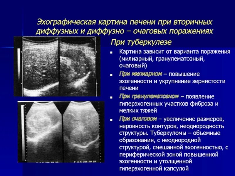 Эхо диффузные изменения. Очаговые изменения печени. очаговые изменения печени на узи. диффузные изменения печени. диффузные и очаговые поражения печени.