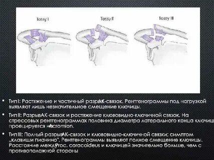 Разрыв акромиально ключичного сочленения