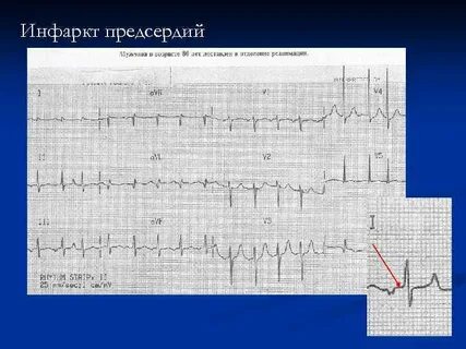 Инфаркт перенесенный на ногах