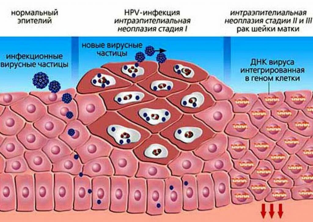 Как вылечить вирус папилломы человека. Папилломавирусная инфекция. попеломофирусная инфекции.