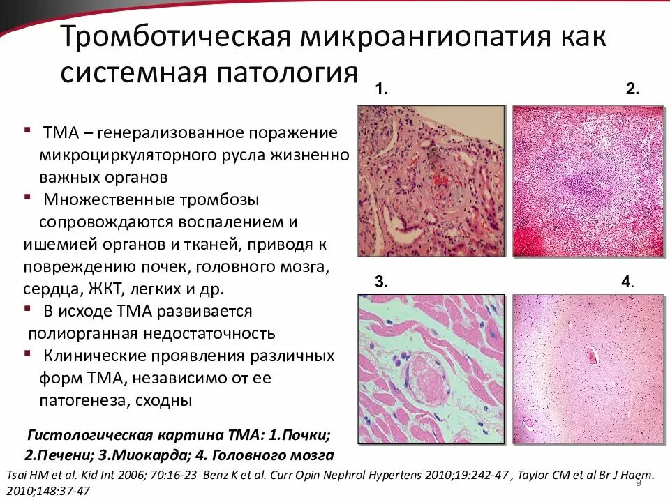 Микроангиопатия головного мозга fazekas. Проявление микроангиопатии головного. Микроангиопатия головного мозга лекарства. При микроангиопатиях характерно поражение. Микроангиопатия симптомы.