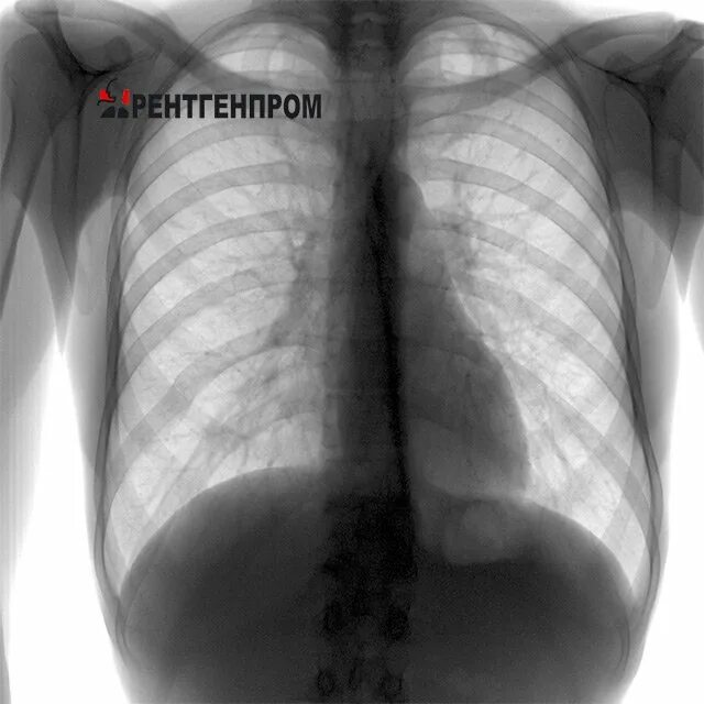 Без видимых патологий. Туберкулез легких снимок флюорографии. Туберкулез легкого рентгенограмма. Флюорография лёгких туберкулез туберкулёз снимки. Флюорография в 2 проекциях.