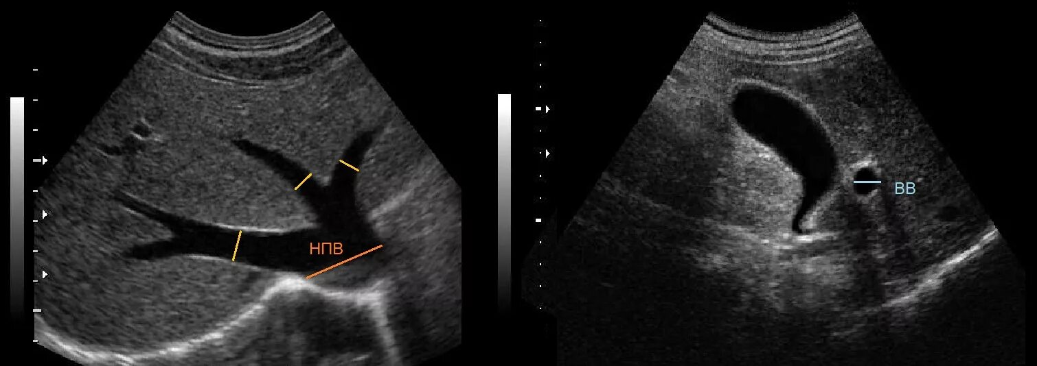 Печеночные вены норма на УЗИ. Норма воротной вены на УЗИ. Нижняя полая Вена на УЗИ печени. Печеночные сосуды на УЗИ норма. Сосуды желчного пузыря