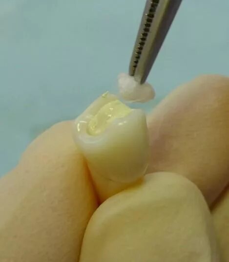 Как снять временную пломбу самостоятельно DentalПлюшки 11- адаптация матрицы YouTube