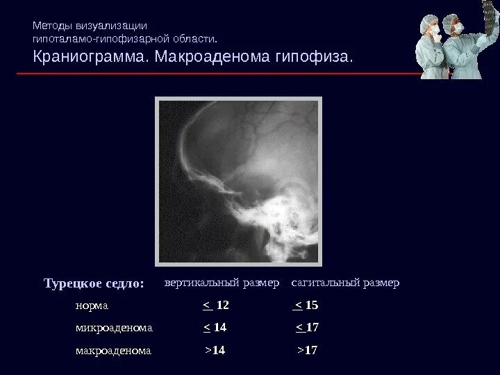 Макроаденома гипофиза. Макроаденома гипофиза