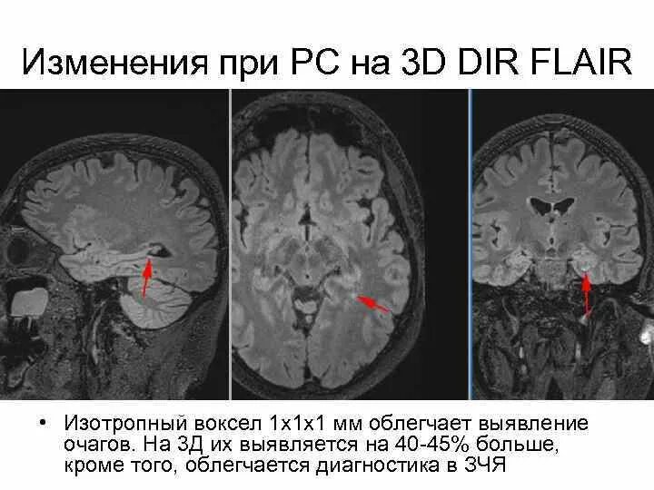 Демиелинизация головного мозга мрт. Очаги демиелинизации на мрт. Очаги демиелинизации головного мозга на мрт. Демиелинизирующее заболевание мрт. Демиелинизация головного