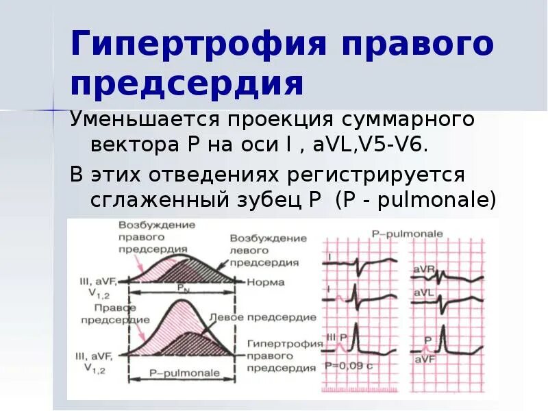 Образование левого предсердия. Гипертрофия правого предсердия на ЭКГ. ЭКГ гипертрофия правого предсер. Гипертрофия правого и левого предсердия. Для гипертрофии правого предсердия характерно:.