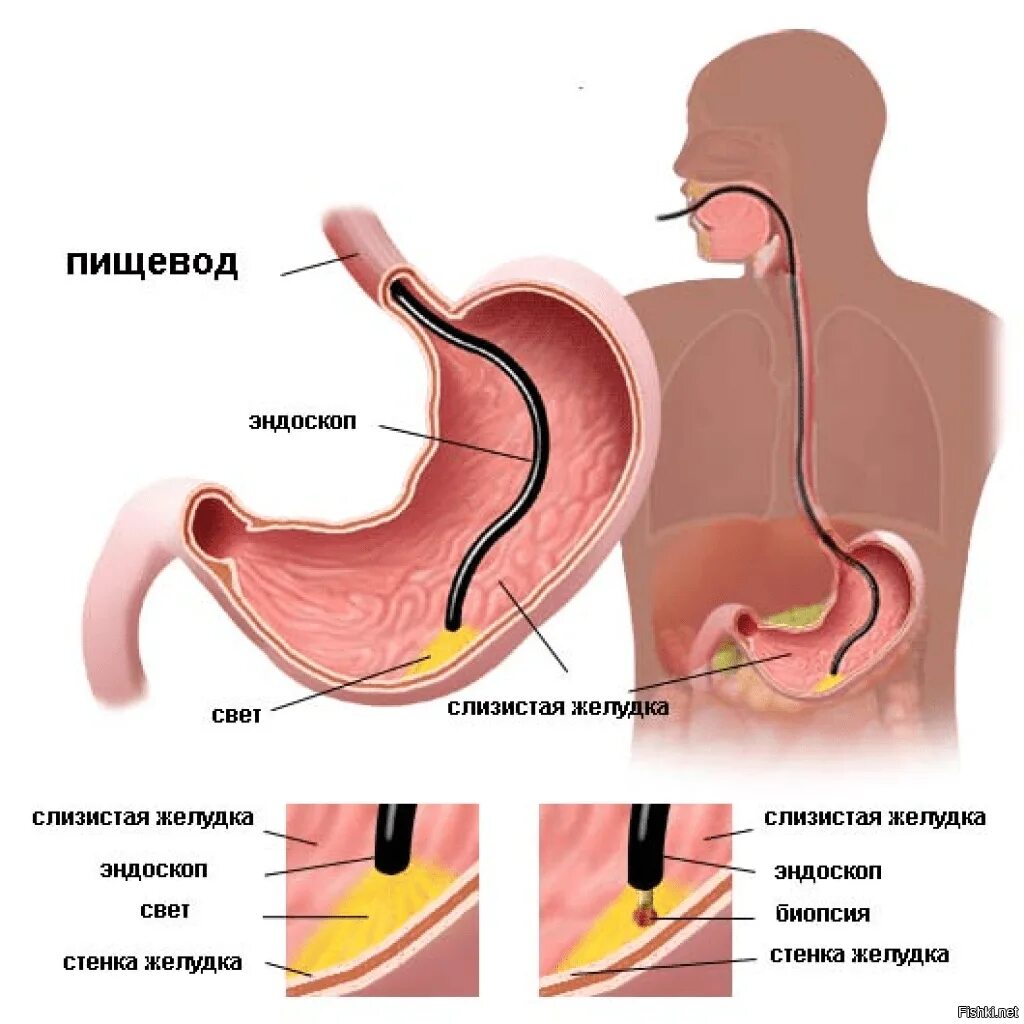 Биоптат кишки. Фиброгастроскопия язва желудка. Эндоскопическое исследование слизистой оболочки пищевода желудка. Язва желудка ФГДС эндоскопия.
