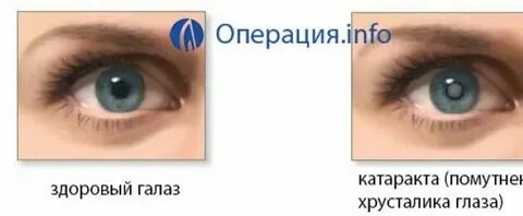 Когда меняют хрусталик глаза