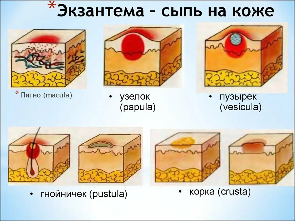 Вторичные элементы поражения. Ветряная оспа пятно папула везикула. Морфологические элементы сыпи папула. Пятно папула везикула корка.