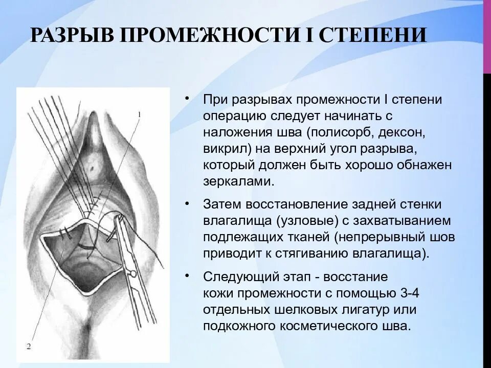 Перинеотомия и перинеорафия что это. Разрыв промежности 2-й степени характеризуется. Разрыв промежности 1 степени. Три степени разрыва промежности.