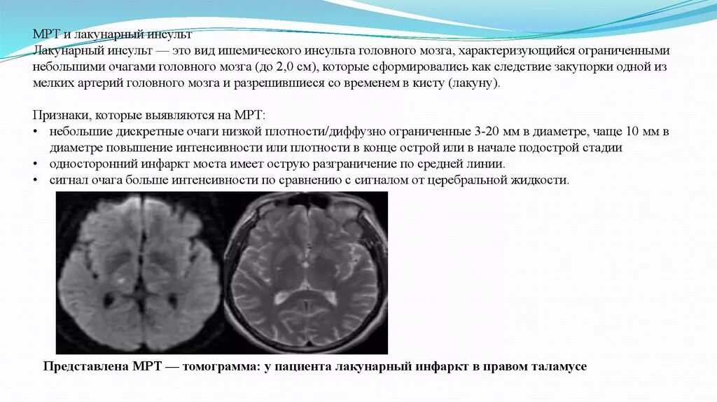 Лакунарный ишемический инсульт кт. Лакунарный ишемический инсульт мрт. Подострая стадия ишемического инсульта мрт. Очаг ишемического инсульта на кт. Что такое ишемический инсульт головного мозга