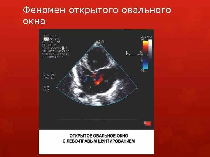 Открытое овальное окно на ЭХОКГ. Открытое овальное окно эхокардиография. Открытое овальное окно Эхо кг. Открытое овальное окно в сердце